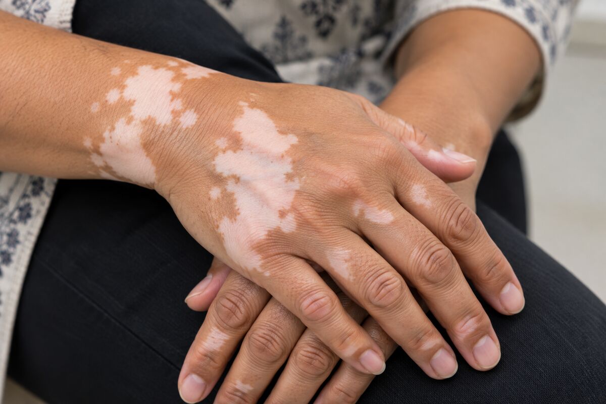 Vitiligo on the hand
